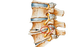 disco pizzicato della colonna vertebrale come causa dell'osteocondrosi cervicale