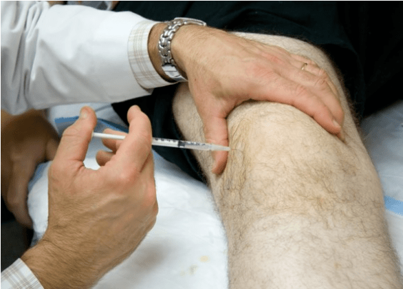 Somministrazione intra -articolare di analgesici nel dolore grave